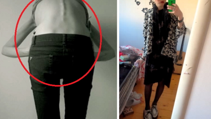 anorexia-tit