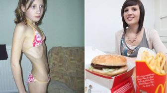 anorexia fast food