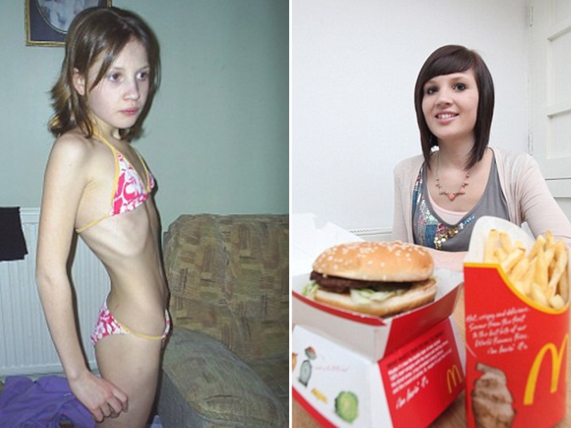 anorexia fast food