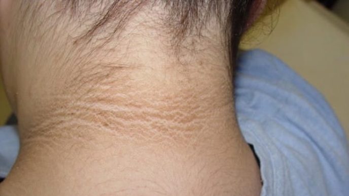 Acanthosis nigricans dermtv.com epi 452 600x450.jpg