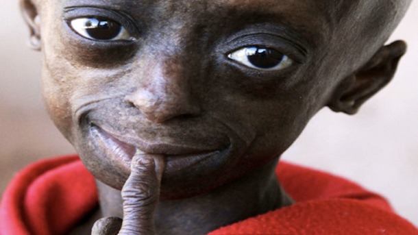 Progeria.png