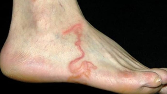 Foot worm 1 664x347.jpg