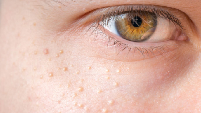 Milia (Milium) - pimples around eye on skin.