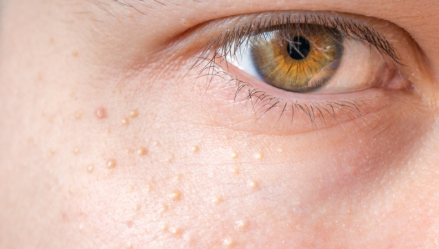 Milia (Milium) - pimples around eye on skin.