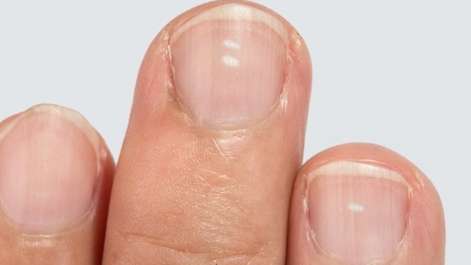 White spots on fingernails