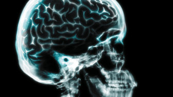 X ray of brain in skull