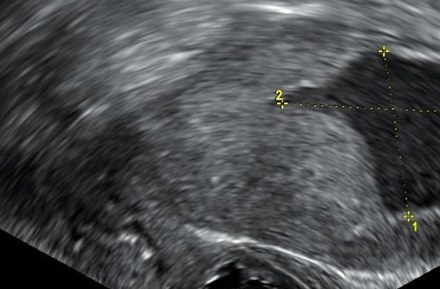 https://en.wikipedia.org/wiki/Uterus#/media/File:Endometrial_fluid_accumulation,_postmenopausal.jpg