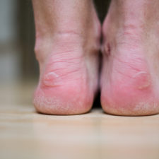 Blister heels