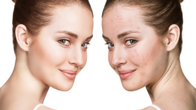 Girl with acne before and after treatment