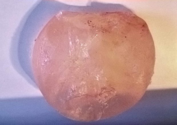 MUM REMOVES HER OWN BREAST IMPLANT