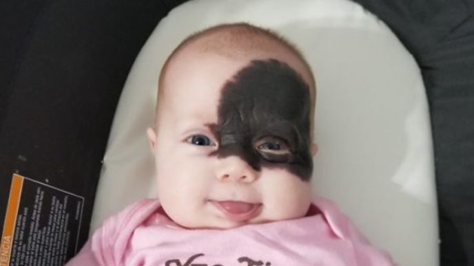 Baby is born with a mark on her face and the parents call her superhero for remembering the mask of batman 5af4e2809bf2d__605.jpg
