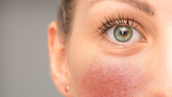 A closeup view on the eye and cheek of a young woman suffering from red blotchy cheeks, blushing caucasian girl with green and teal eyes and copy space on the left.