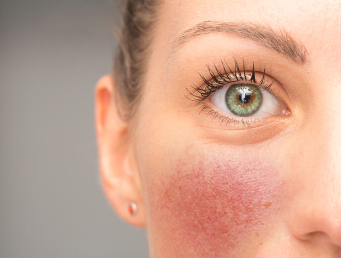 A closeup view on the eye and cheek of a young woman suffering from red blotchy cheeks, blushing caucasian girl with green and teal eyes and copy space on the left.
