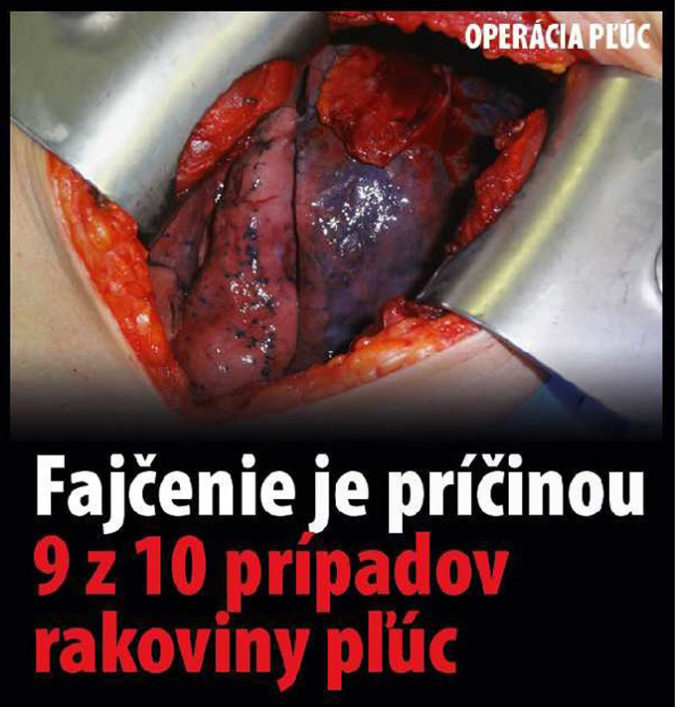VLÁDA: Varovné obrázky na cigaretách