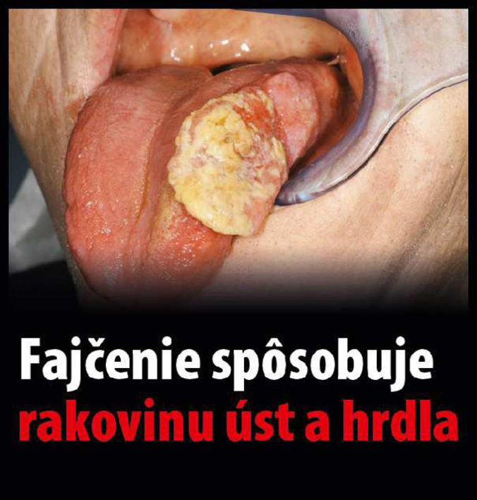 VLÁDA: Varovné obrázky na cigaretách