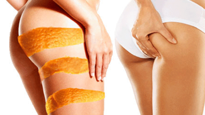 Slide_cellulitis.gif