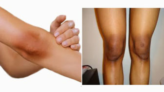 15 effective tips to get rid of black knees and elbow.jpg