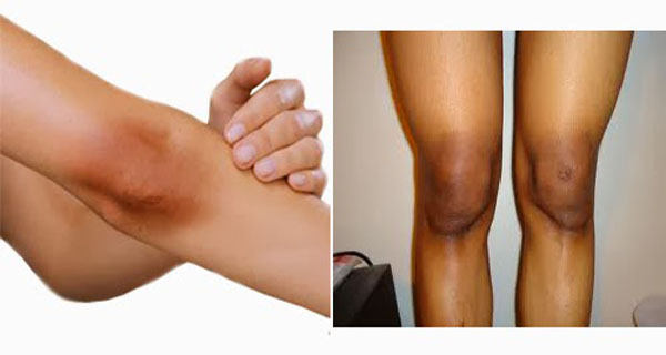 15 effective tips to get rid of black knees and elbow.jpg