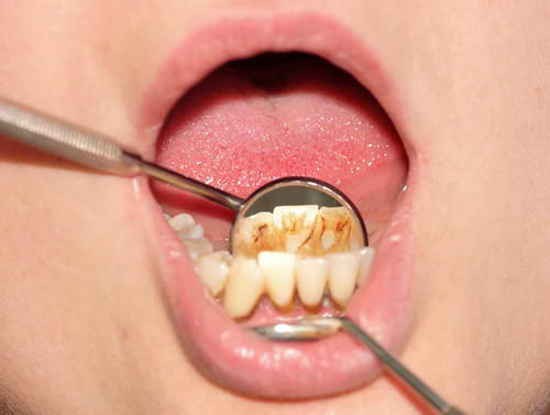 Tartar plaque on frontal teeth and gingivitis.jpg