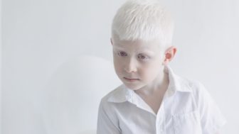 Fotografie albinismu yulia taits.jpg