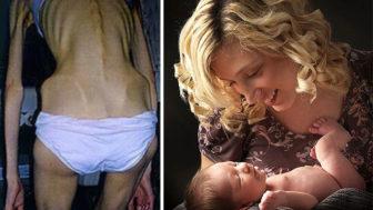 Anorexia recovery before after 157 59006340e11ec__700 1.jpg