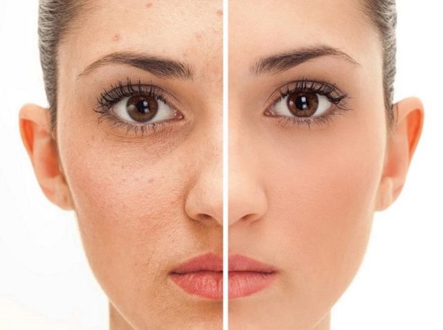 00f1d32051bf468285e11283f35718ce how to treat acne acne scar removal.jpg