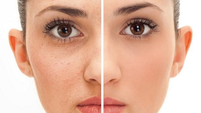 00f1d32051bf468285e11283f35718ce how to treat acne acne scar removal.jpg