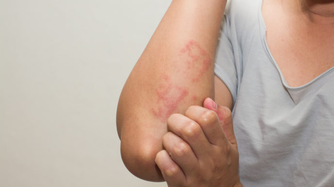 Atopická dermatitida 3shutterstock_530454109.jpg