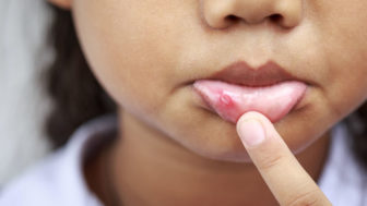 Child with canker sore 825x550.jpg