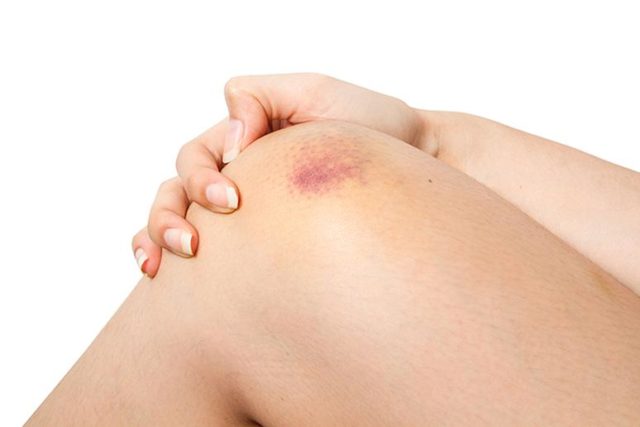 1_bruise_shutterstock_edit.jpg