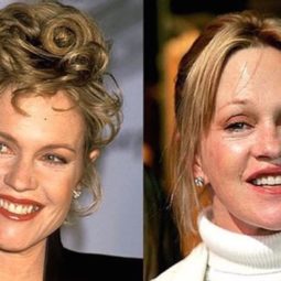 20 celebrities who have undergone plastic surgery 7.jpg