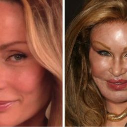 20 worst cases of celebrity plastic surgery gone wrong 4.jpg