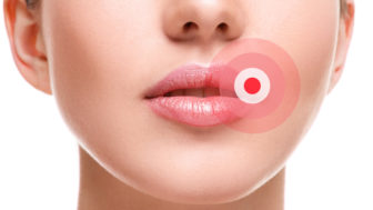Female lips affected by herpes virus