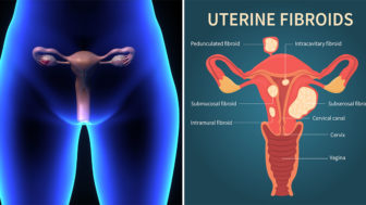 Ako zistiť, že máte myóm na maternici? Existuje niekoľko príznakov