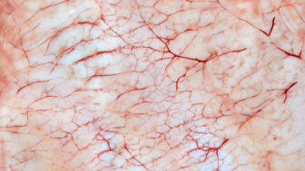 Bloody inflammatory capillaries on the skin