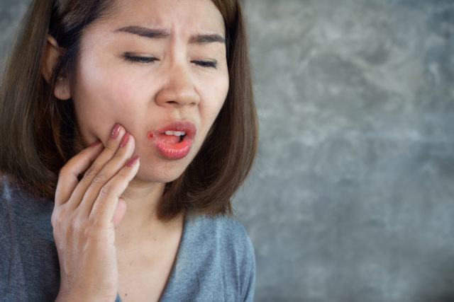Asian woman having problem with mouth disease dry skin on corner of lips or Angular cheilitis
