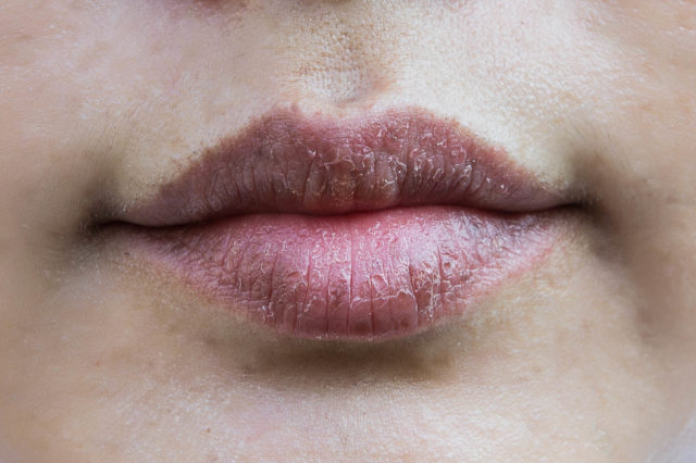 Lips hypersensitive to dry lips, Lips allergic to chemicals , Black lips