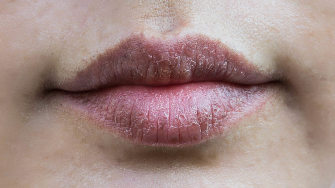 Lips hypersensitive to dry lips, Lips allergic to chemicals , Black lips
