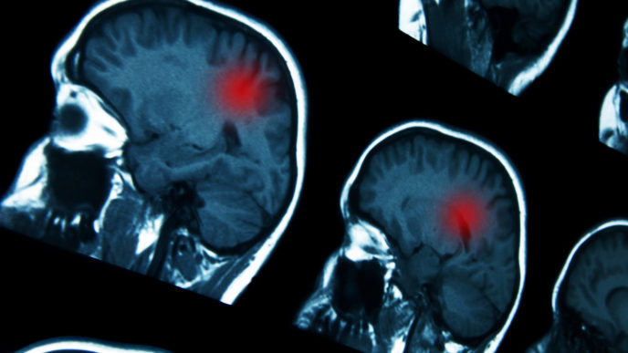 MRI