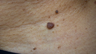 Ako odstrániť bradavice