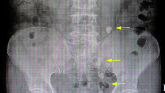 8 varovných príznakov obličkových kameňov