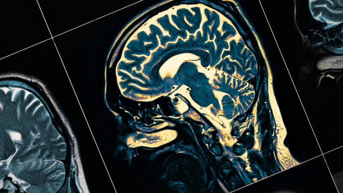 MRI
