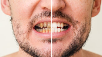 ako prirodzene a okamžite vybieliť zuby