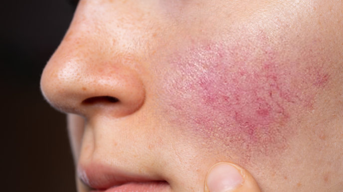 rosacea