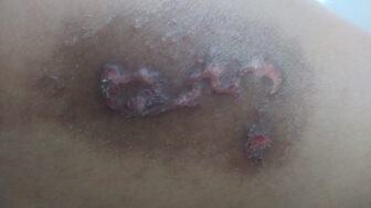 cutaneous larva migrans