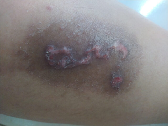 cutaneous larva migrans