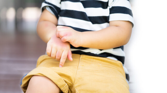 potravinová alergia u deťaťa