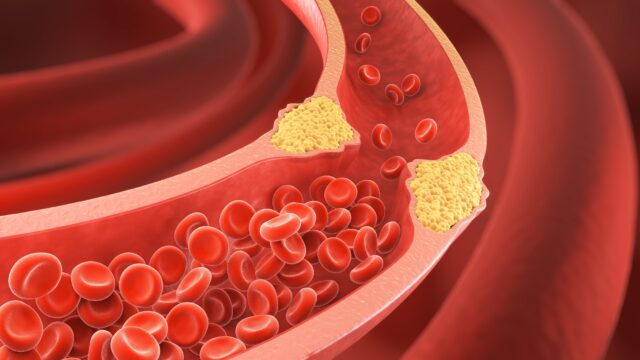 Cholesterol