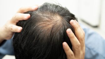 alopecia