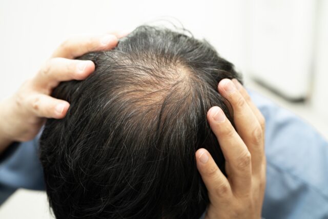 alopecia